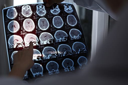 Multiple Sclerosis Treatment