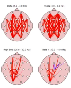 qeeg Brain Mapping Tampa Fl