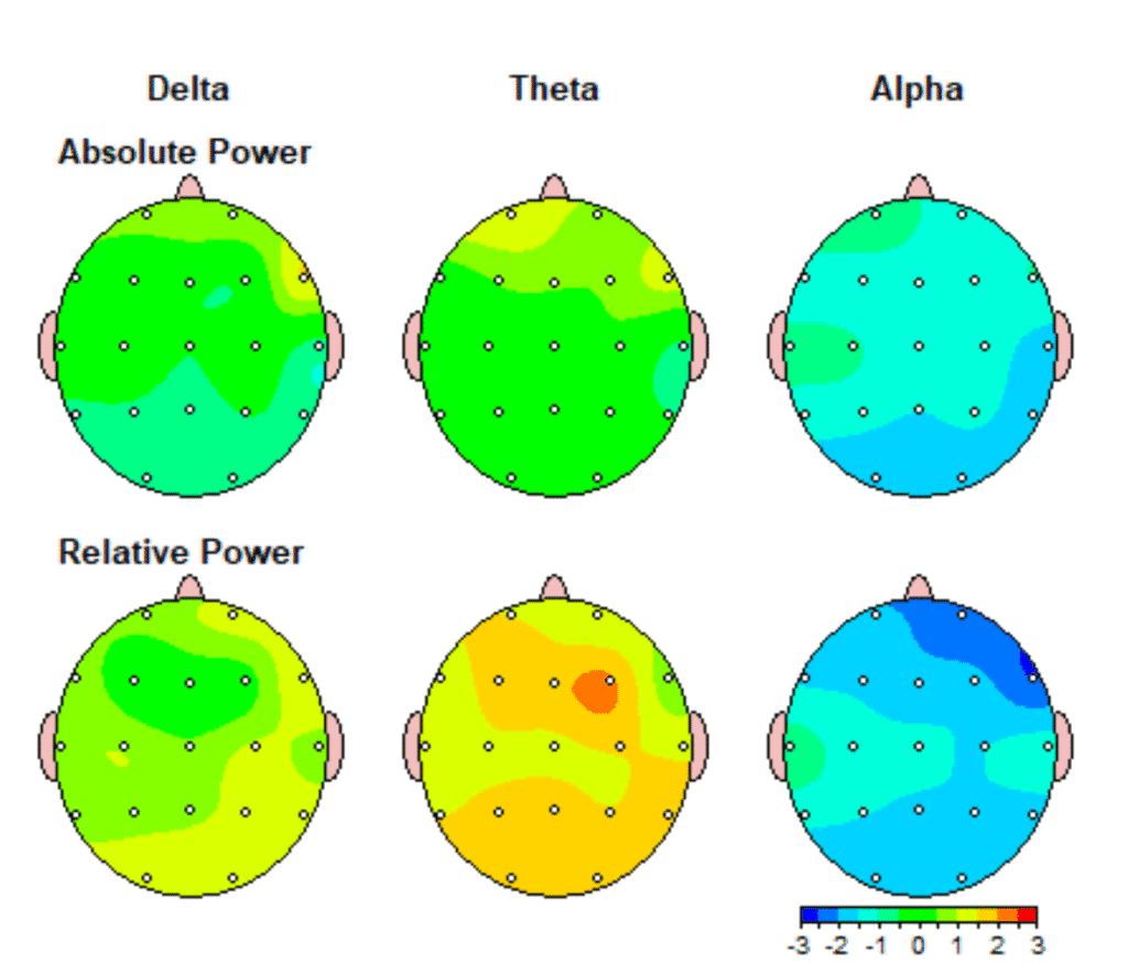 qEEG Brain Mapping Tampa Bay