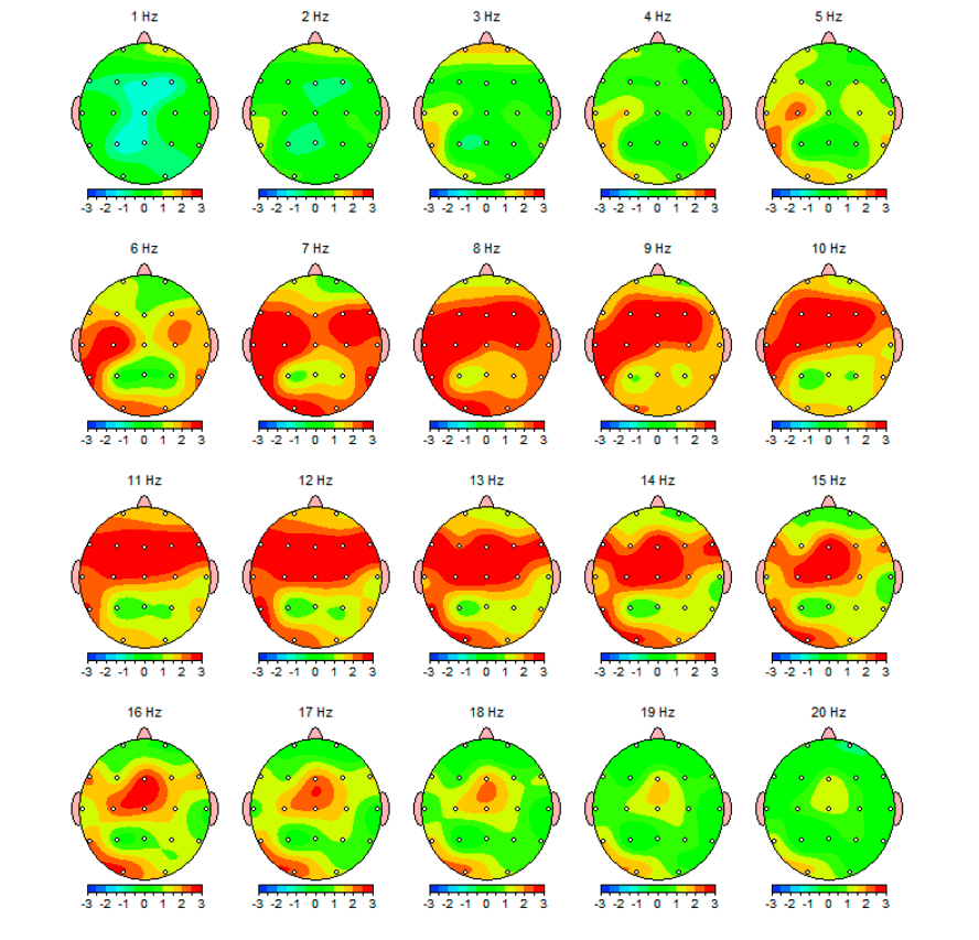 qEEG Brain Map Showing Anxiety