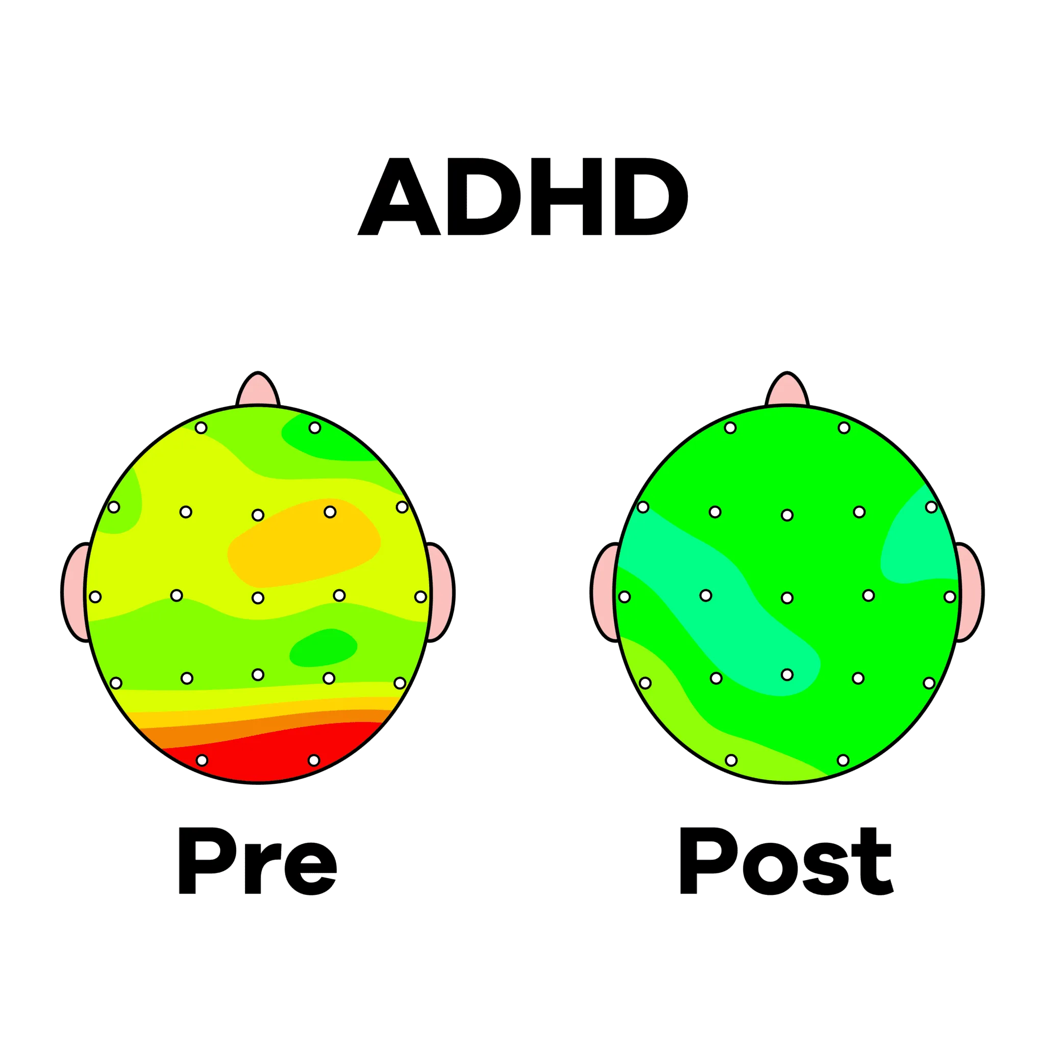 ADHD PRE POST NEW Tampa | Genesis Brain Institute