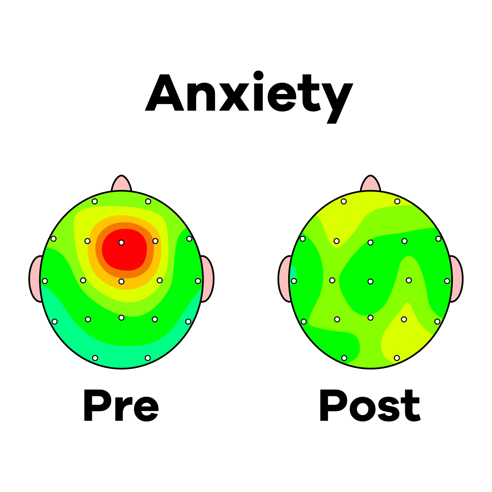 ANXIETY PRE POST NEW Tampa | Genesis Brain Institute