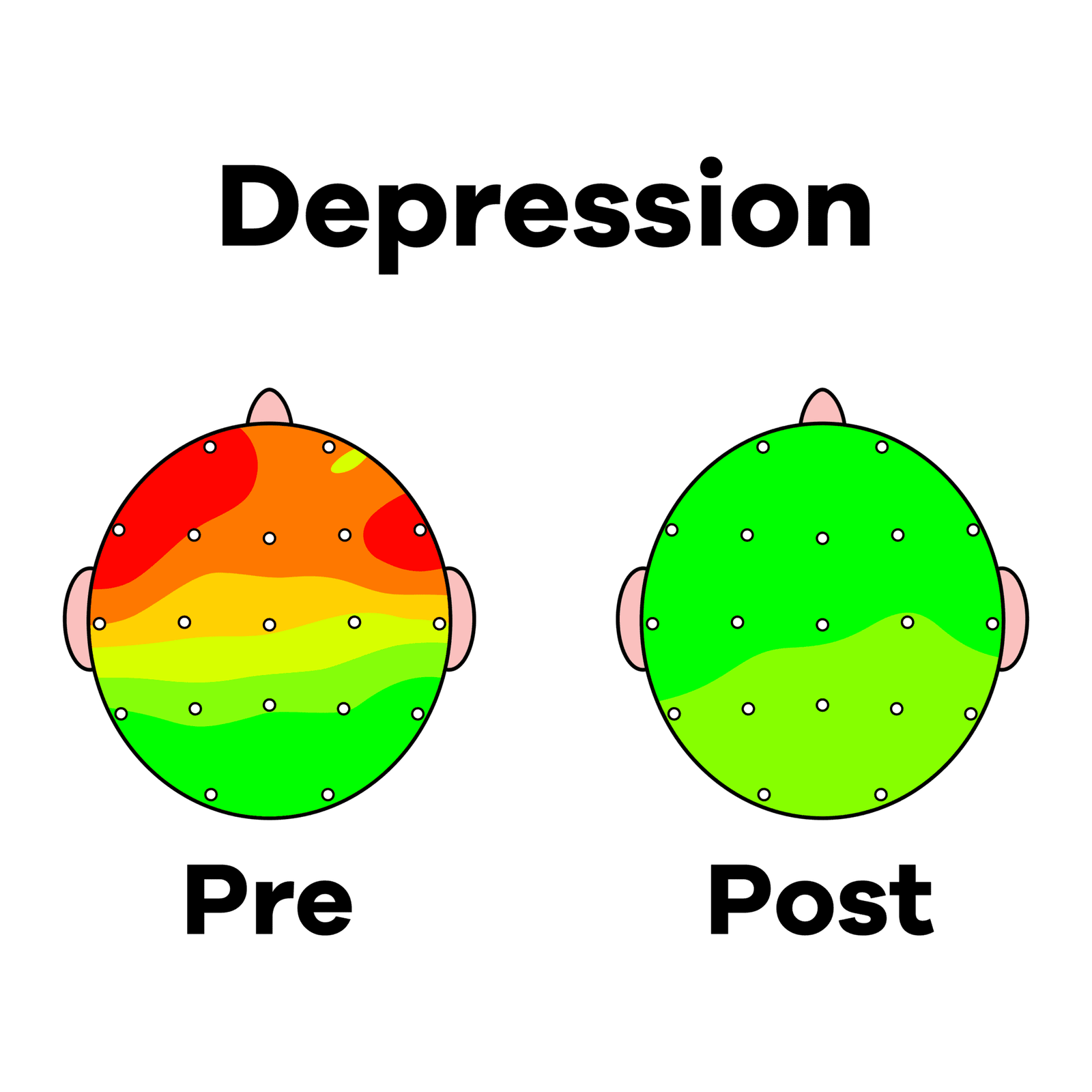 DEPRESSION PRE POST NEW Tampa | Genesis Brain Institute