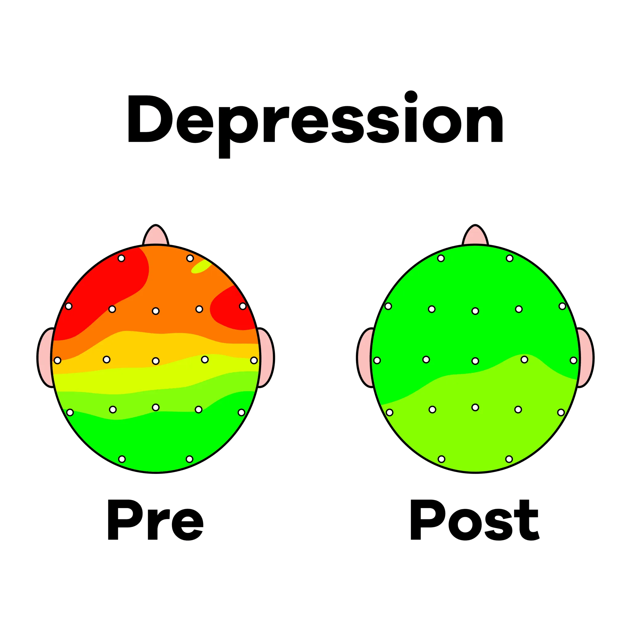 DEPRESSION PRE POST NEW Tampa | Genesis Brain Institute