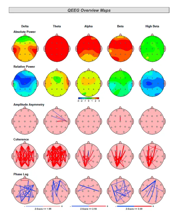 brain fog qEEG Brain map