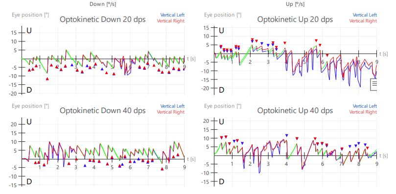 Eye Movement Test Optocinetic Response