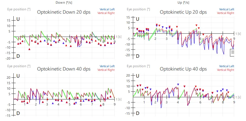 Eye Movement Test Optocinetic Response